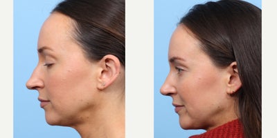 Case 3660 - 25-34 year old woman treated with Rhinoplasty