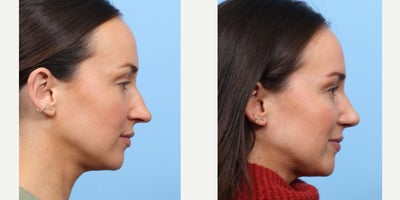 Case 3661 - 25-34 year old woman treated with Rhinoplasty