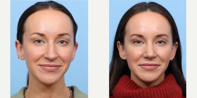 Case 3662 - 25-34 year old woman treated with Rhinoplasty