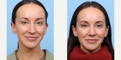 Case 3663 - 25-34 year old man treated with Rhinoplasty