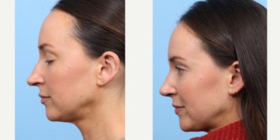 Case 3664 - 25-34 year old man treated with Rhinoplasty