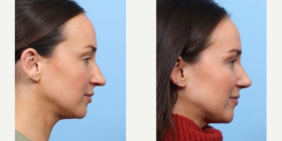 Case 3665 - 25-34 year old man treated with Rhinoplasty