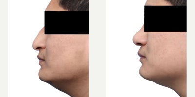 Case 3667 - 18-24 year old man treated with Rhinoplasty