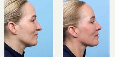 Case 3668 - 35-44 year old woman treated with Rhinoplasty