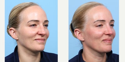 Case 3669 - 35-44 year old woman treated with Rhinoplasty