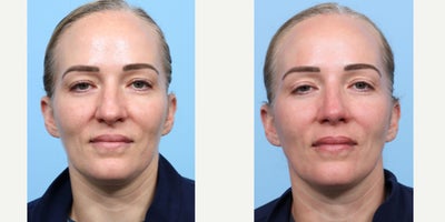 Case 3670 - 35-44 year old woman treated with Rhinoplasty