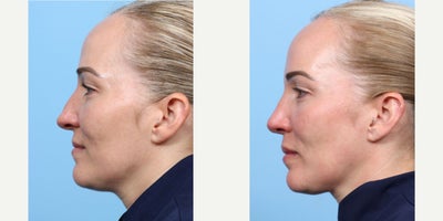 Case 3671 - 35-44 year old woman treated with Rhinoplasty