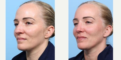 Case 3672 - 35-44 year old woman treated with Rhinoplasty