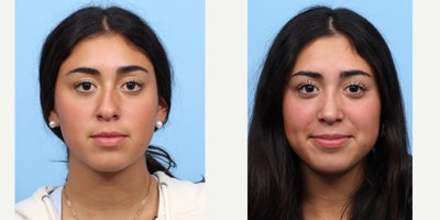 Case 3675 - 17 or under year old woman treated with Rhinoplasty