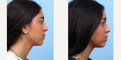 Case 3676 - 17 or under year old woman treated with Rhinoplasty