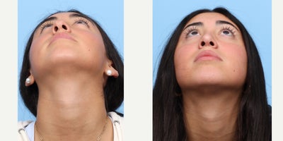 Case 3677 - 17 or under year old woman treated with Rhinoplasty