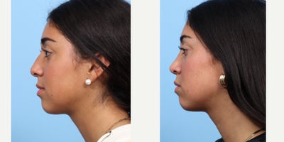 Case 3678 - 17 or under year old woman treated with Rhinoplasty