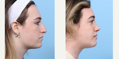 Case 3679 - 18-24 year old woman treated with Rhinoplasty
