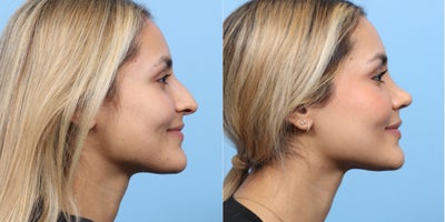 Case 3686 - 25-34 year old woman treated with Rhinoplasty