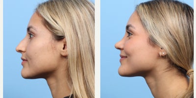 Case 3687 - 25-34 year old woman treated with Rhinoplasty