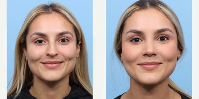Case 3688 - 25-34 year old woman treated with Rhinoplasty