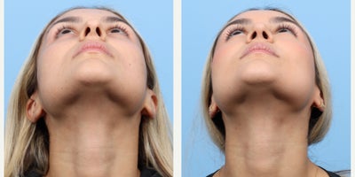 Case 3689 - 25-34 year old woman treated with Rhinoplasty