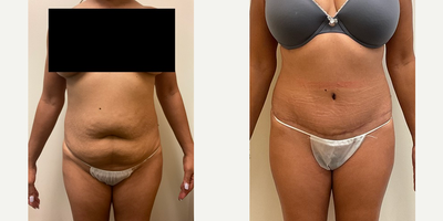 Case 369 - Woman treated with Tummy Tuck
