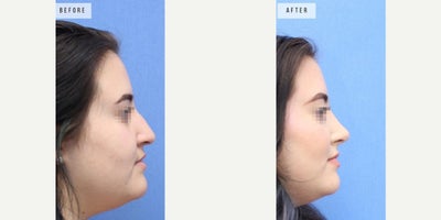 Case 3690 - Woman treated with Rhinoplasty