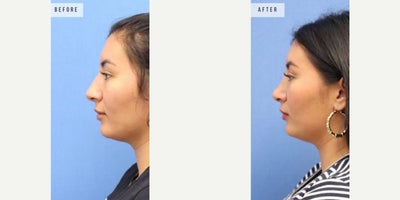 Case 3691 - Woman treated with Rhinoplasty