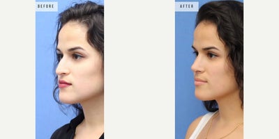 Case 3692 - Woman treated with Rhinoplasty