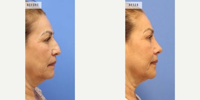 Case 3693 - Woman treated with Rhinoplasty