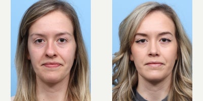 Case 3694 - 25-34 year old woman treated with Rhinoplasty