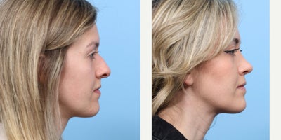 Case 3695 - 25-34 year old woman treated with Rhinoplasty
