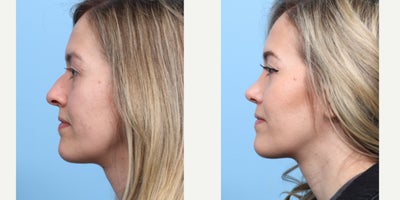 Case 3696 - 25-34 year old woman treated with Rhinoplasty