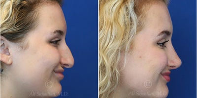 Case 3698 - Woman treated with Rhinoplasty
