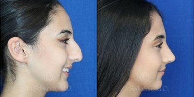 Case 3699 - Woman treated with Rhinoplasty