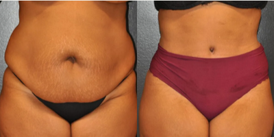 Case 37 - Woman treated with Tummy Tuck