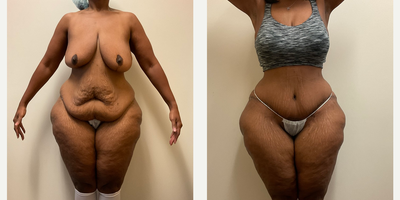 Case 370 - Woman treated with Liposuction, Tummy Tuck