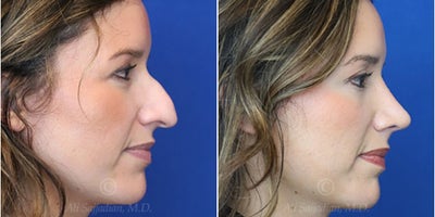 Case 3700 - Woman treated with Rhinoplasty