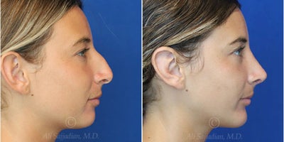 Case 3701 - Woman treated with Rhinoplasty