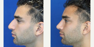 Case 3703 - Man treated with Rhinoplasty