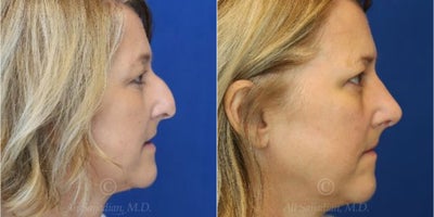 Case 3704 - Woman treated with Rhinoplasty