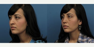 Case 3705 - Woman treated with Rhinoplasty