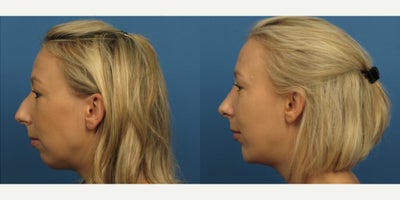 Case 3706 - Woman treated with Rhinoplasty