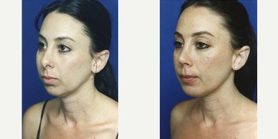 Case 3707 - Woman treated with Rhinoplasty