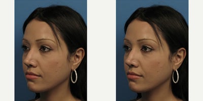 Case 3708 - Woman treated with Rhinoplasty