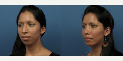 Case 3709 - Woman treated with Rhinoplasty
