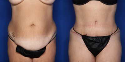 Case 371 - 45-54 year old woman treated with Tummy Tuck