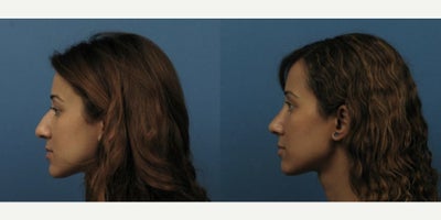 Case 3710 - Woman treated with Rhinoplasty