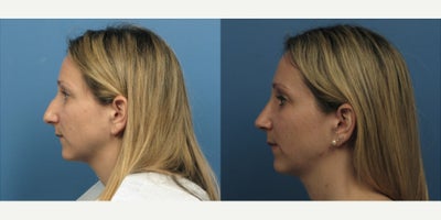 Case 3711 - Woman treated with Rhinoplasty