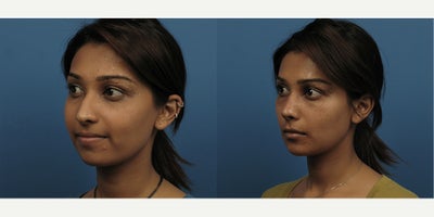 Case 3712 - Woman treated with Rhinoplasty