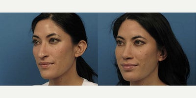 Case 3713 - Woman treated with Rhinoplasty