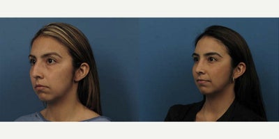 Case 3714 - Woman treated with Rhinoplasty