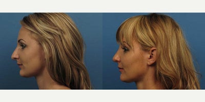 Case 3715 - Woman treated with Rhinoplasty