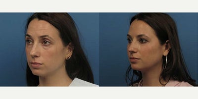 Case 3716 - Woman treated with Rhinoplasty